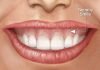 Mẹo cười không hở lợi giúp bạn tỏa sáng