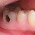 Răng bị mẻ có mọc lại không?