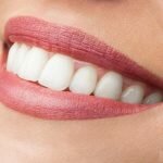 Quy trình mài răng hô bọc răng sứ
