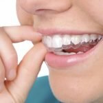 Hãy thử ngay cách tẩy trắng răng không đều màu sau đây