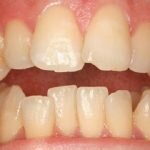 Các loại niềng răng mắc cài hiệu quả nhất