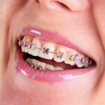 Niềng răng cửa ở đâu tốt? Làm thế nào để nhận biết?