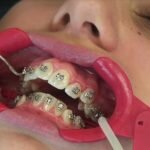 Niềng răng là gì – Niềng răng có ảnh hưởng gì không?