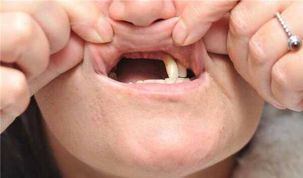 Bị mất răng hàm lâu năm phải làm sao?
