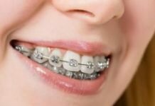 niềng răng có ảnh hưởng gì không?